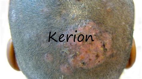 How To Pronounce Kerion Youtube