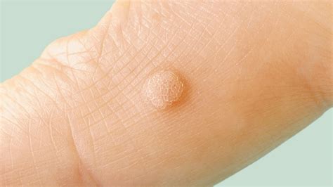 How To Detect Warts Punchtechnique6