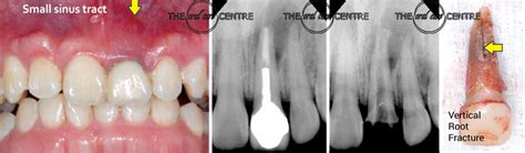 Tooth Fracturecracked Tooth Causes Diagnosis And Treatments