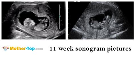 11 Weeks Pregnant — Fetal Development And Mothers Health