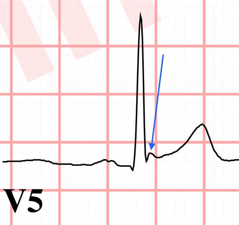 J Point Notching Ecg