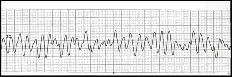 Float Nurse Ekg Rhythm Strip Quiz 142