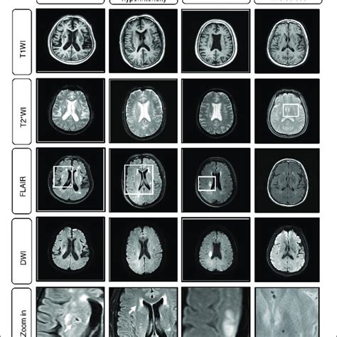 Example Cases Of Cerebral Small Vessel Disease Csvd Mri A