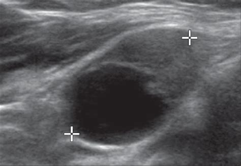 Year Old Woman With Level Ii Metastatic Lymph Nodes In Left Neck