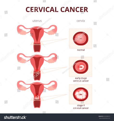 cervical cancer schematic illustration uterus cervix stock vector royalty free 432289015