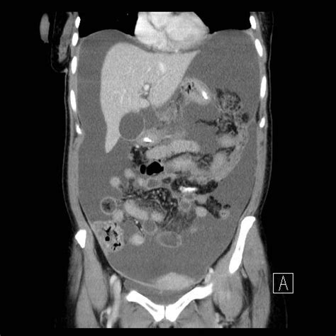 Primary Peritoneal Carcinoma Image