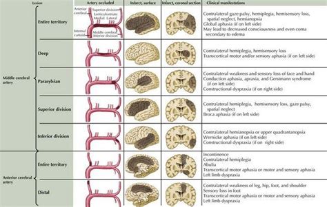 The middle cerebral artery occlusion (mcao) model has been utilized extensively, especially in rodents. CanadaQBank® | Spatial, Aphasia, Manifestation