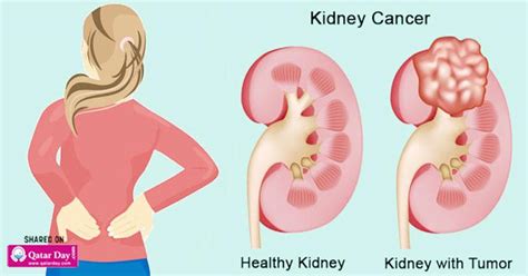 But as a kidney tumor grows, symptoms might occur. 11 Signs of Kidney Cancer (and How to Manage it Naturally)
