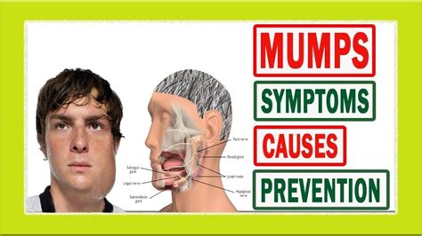 Mumps Causes Symptoms And Treatment Cool News Bytes