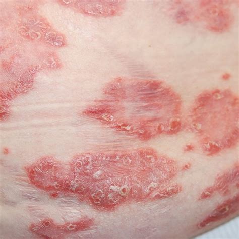 Case 1 Compounded Topical Preparation For Plaque Psoriasis Download