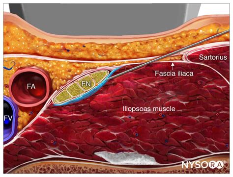Ultrasound Guided Femoral Nerve Block Nysora