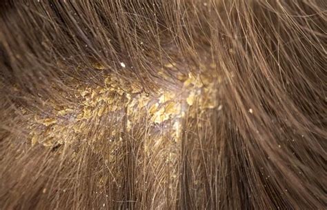 Different Types Of Dandruff And How To Prevent Them