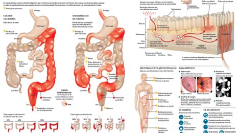 ENFERMEDAD DE CROHN Enfermedad De Crhon