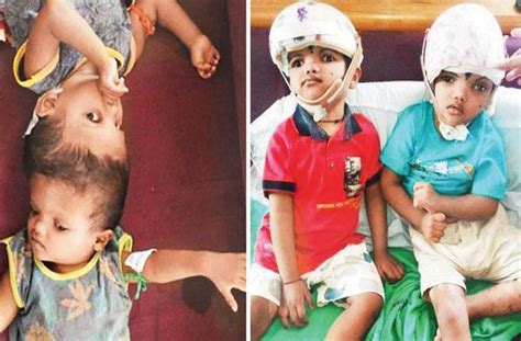Offbeat News Odisha Surgery That Separated Conjoined Twins Features In Limca Books Of Records