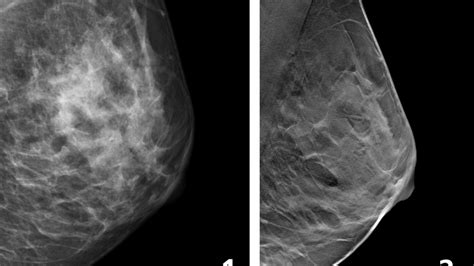 Fewer Breast Cancer Cases Between Screening Rounds With 3d Mammography