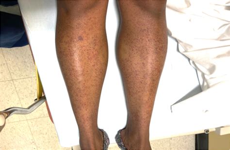 Figure 1 Petechiae Of The Lower Extremities Acute Severe