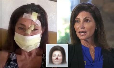 Woman Who Lost Nose To Skin Cancer Has Amazing Nasal Reconstruction