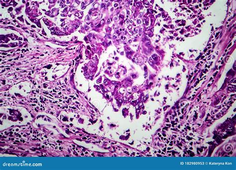 Breast Ductal Carcinoma Light Micrograph Stock Image Image Of