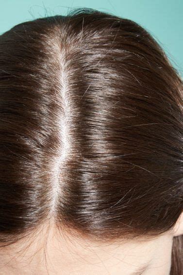 Dandruff And Dry Scalp Issues A Dermatologist Tells All All Things