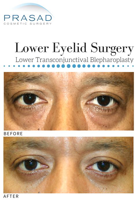 Plastic Surgery For Bags Under Eyes Before And After
