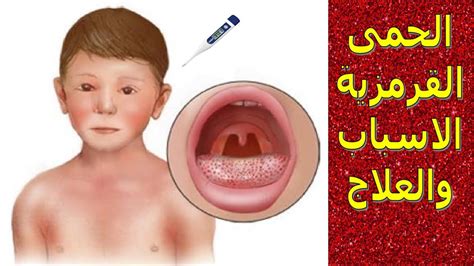 الحمى القرمزية😣 تعرف على الاسباب والاعراض والوقاية منها والتشخيص📝وروشتة