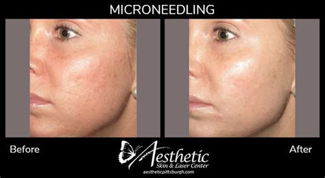 Collagen Pin Microneedling Before And After Photos Pittsburgh Pa
