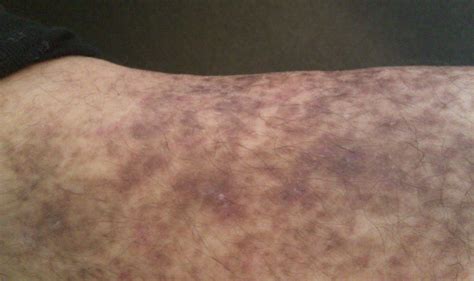 I Have Purple Spots On My Lower Legs That I Have Been Told Is