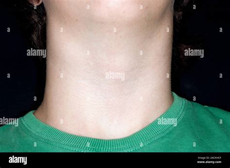 Swollen Glands In The Neck Cervical Lymphadenopathy At Left In A 17
