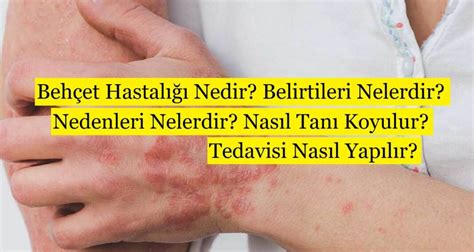 behçet hastalığı nedir belirtileri nelerdir tanı ve tedavisi nasıldır