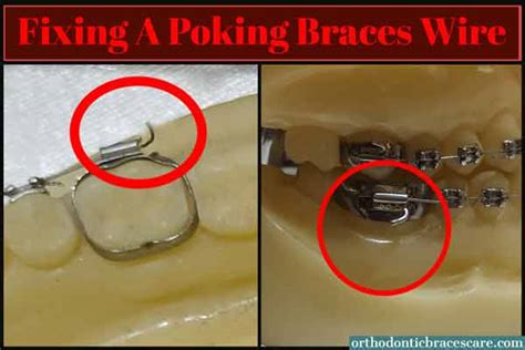 Braces Wire Popped Out Of Bracket How To Fix Orthodontic Braces Care