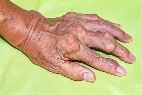 Severe Gout In Men Suffering From Joint Pain Bone Pain Gout