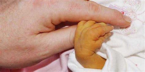 Things To Know About Neonatal Jaundice Dr Thind