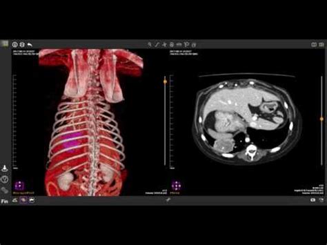 Its symptoms are diverse and many symptoms overlap with other diseases. dog lung cancer - YouTube