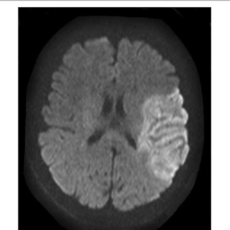 Magnetic Resonance Imaging With Restricted Diffusion Representing Acute