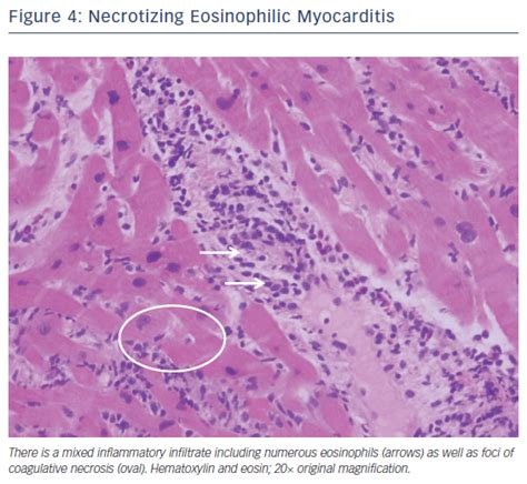 The term myocarditis refers to an inflammatory response within the myocardium that is not secondary to ischemic events or cardiac rejection in the setting of transplantation. Fulminant Myocarditi - US Cardiology Review