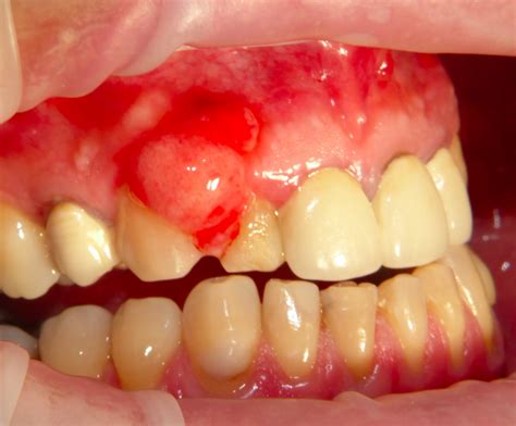 Gingival Swelling Adjacent To The Dental Elements Roots A Clinical