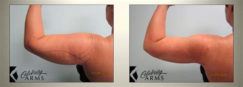 Arm Liposuction Before After Results Celebrity Arms Large Art Lipo