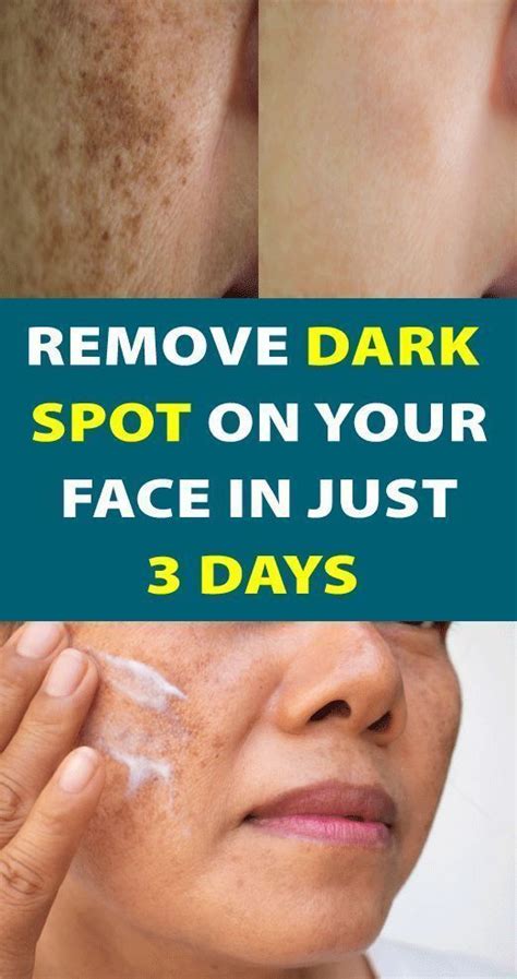 Simple Trick To Remove Brown Spots From Your Skin Remove Dark Spots Good Skin Tips Skin Spots