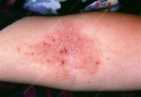 Close Up Of Eczema In The Crook Of The Elbow Stock Image M1500096