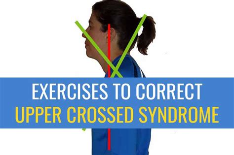 Exercises To Correct Upper Crossed Syndrome Sports Injury Physio