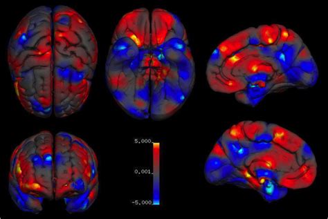 Males And Females Differ In Specific Brain Structures