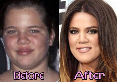 If there ever was a family who was perpetually surrounded by speculation and there might be a chance that khloe's curiosity of plastic surgery might have been forged by her older sister kim's past procedures or it could simply be. Khloe Kardashian Nose Job Before After Photos | Khloe ...