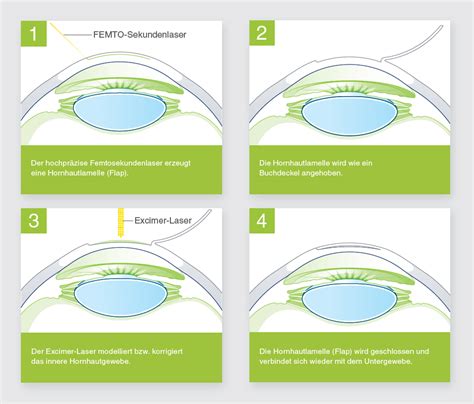 Wie Funktioniert Das Augenlasern