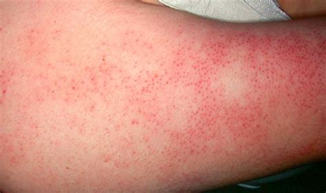 Causes And Treatment Of Big Red Spots On Skin Skincarederm My Xxx Hot