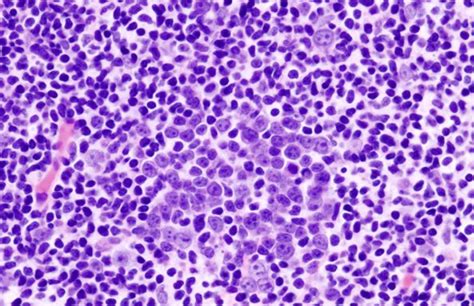 Diffuse Large B Cell Lymphoma Staging Dlbcl