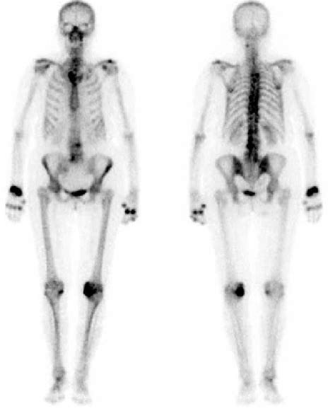 Planar Whole Body Delayed Phase 99m Tc Mdp Bone Scan In The Anterior