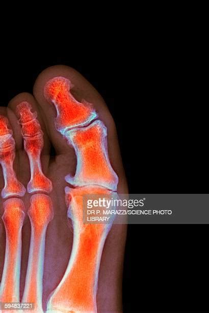 Toe Deformity Photos And Premium High Res Pictures Getty Images