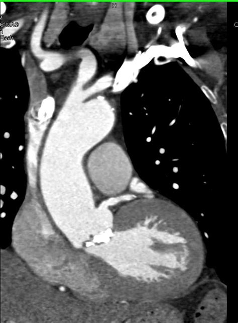 Bicuspid Valve With Extensive Calcification And Aortic Stenosis
