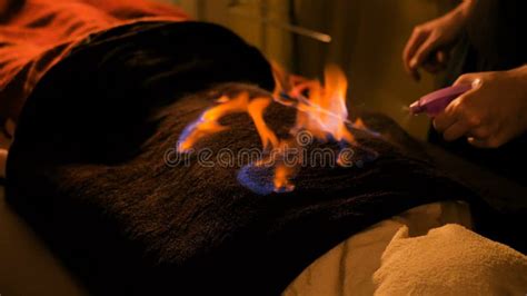 Chinese Fire Massage And Therapy Stock Image Image Of Orange Massaging 167436223