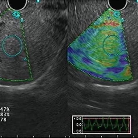 Endoscopic Ultrasound Guided Drainage Of Biloma A Post Operative